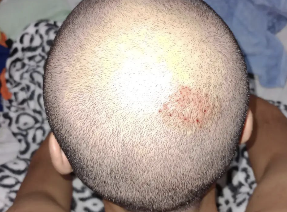 Cabeça de Lucas Ilha Grande após agressões sofridas | Reprodução/Instagram