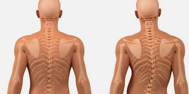 Junho Verde: Ortopedista do Imot fala sobre a escoliose