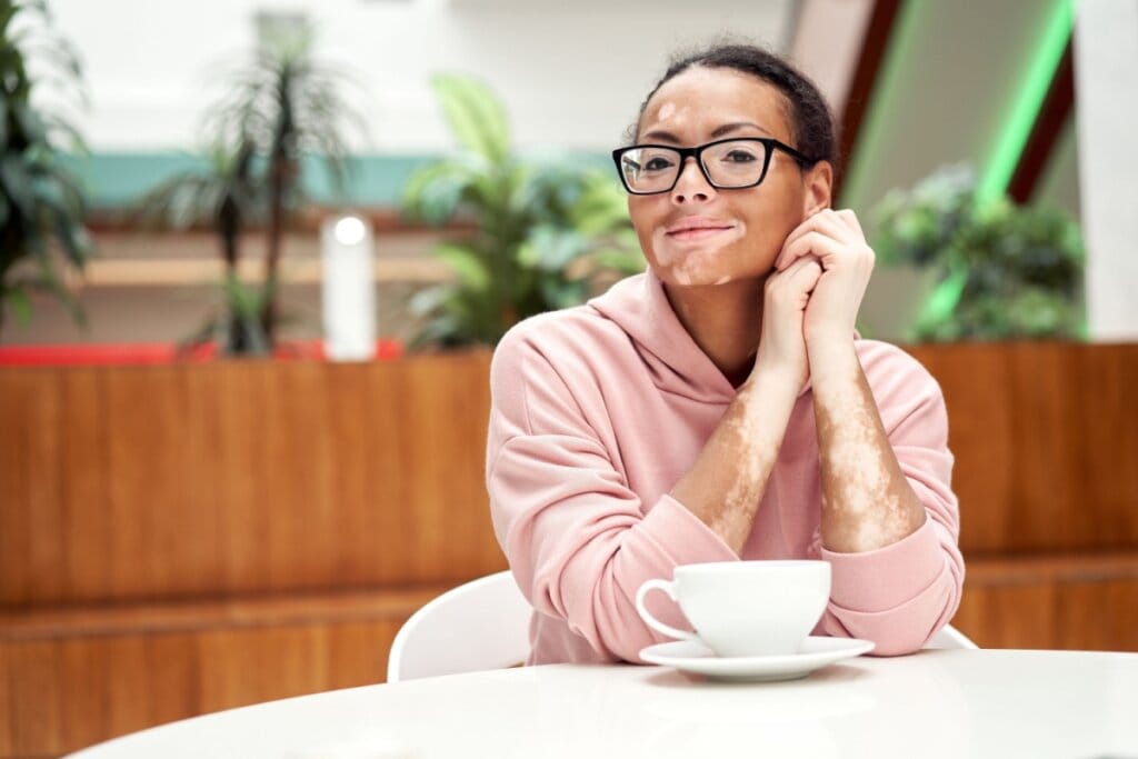 Conheça os principais sinais do vitiligo
